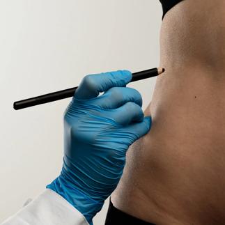 Preparing for Cosmetic Surgery with Markings on Abdomen