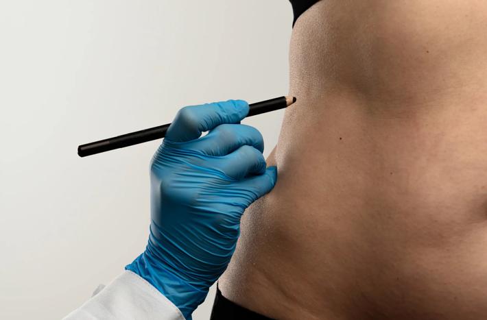 Preparing for Cosmetic Surgery with Markings on Abdomen